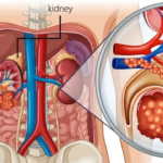 kanker ginjal vidi aldiano