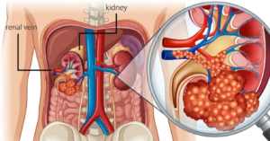kanker ginjal vidi aldiano